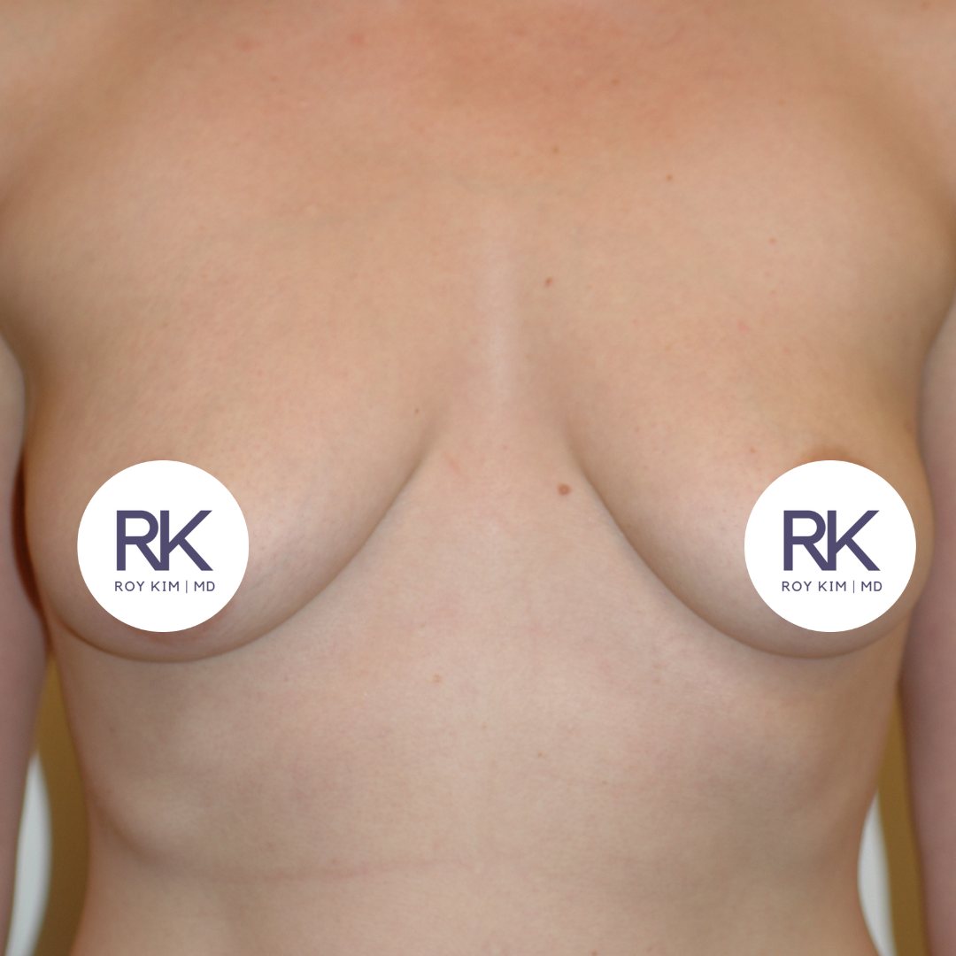Before breast augmentation 325cc