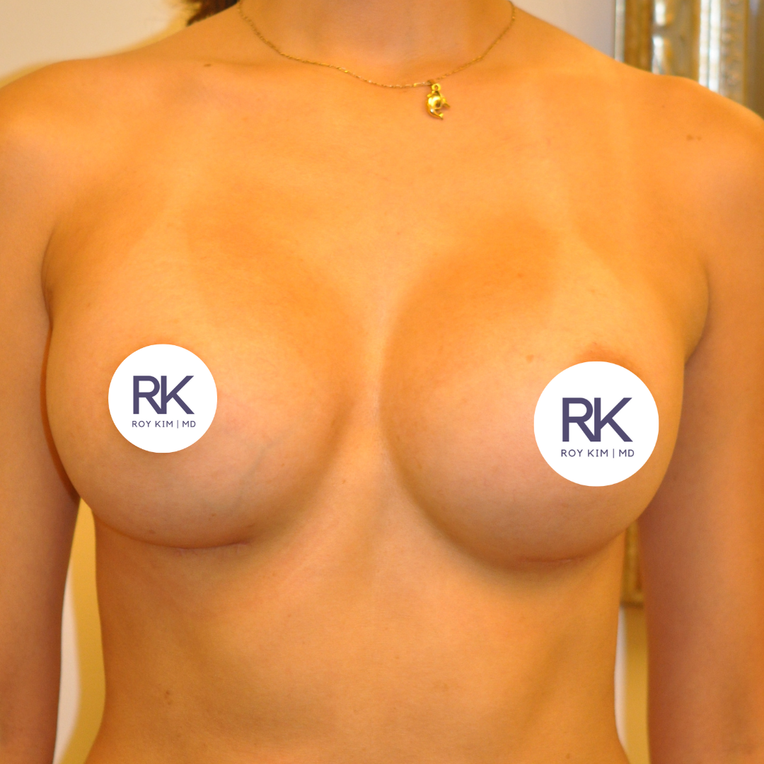 After breast augmentation 450cc