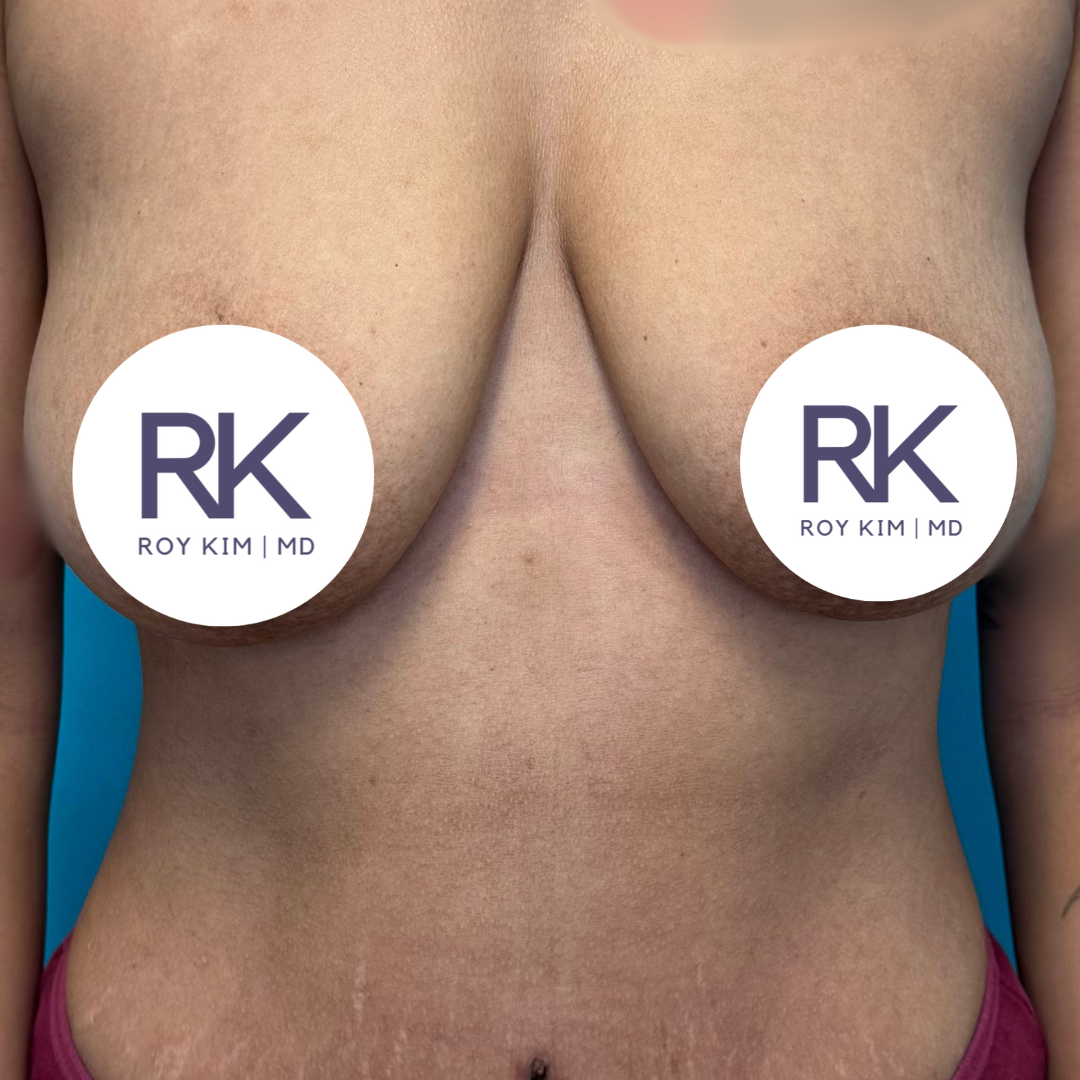 Before breast augmentation 325cc