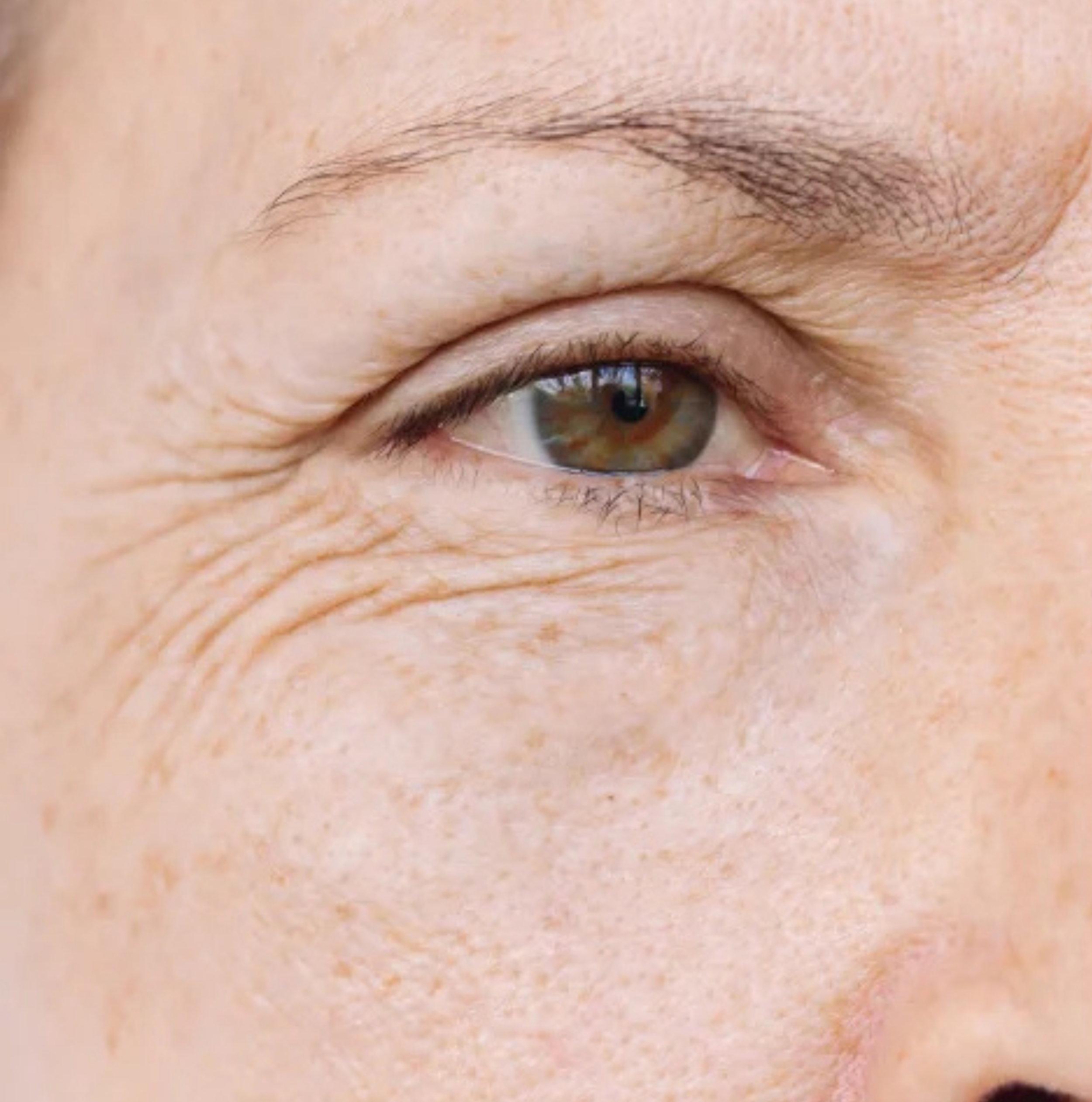 Before dermal fillers