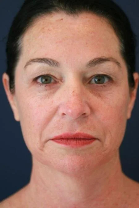 Before laser resurfacing