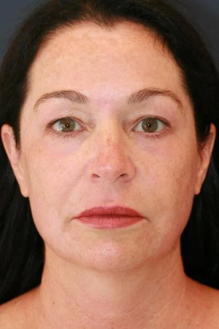 After laser resurfacing
