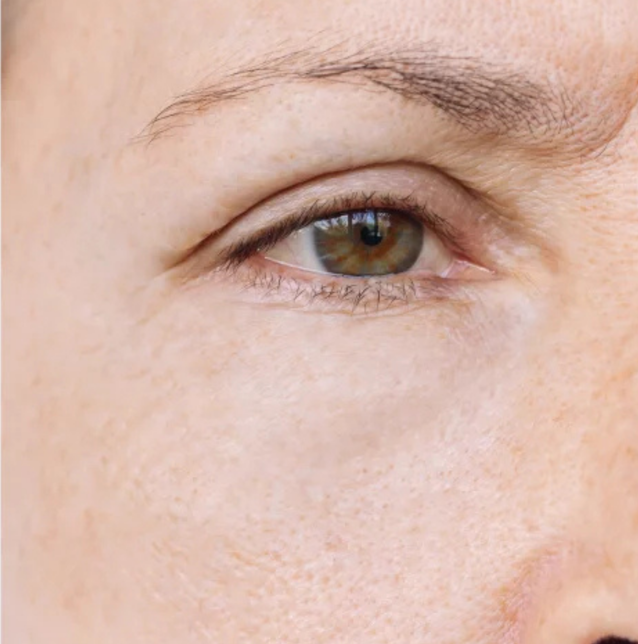 After dermal fillers