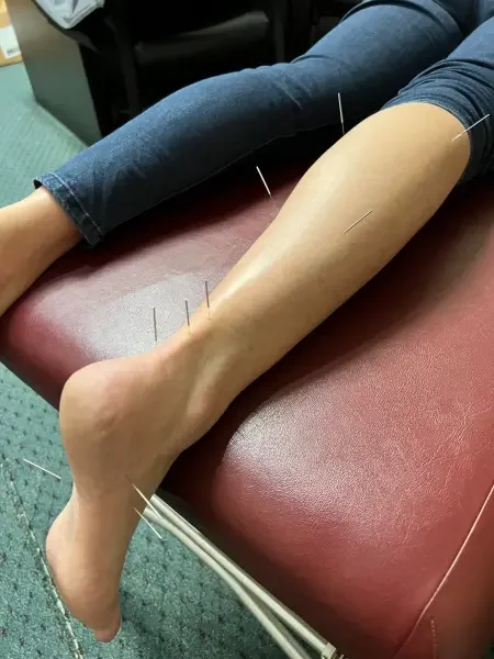 Dry needling leg treatment