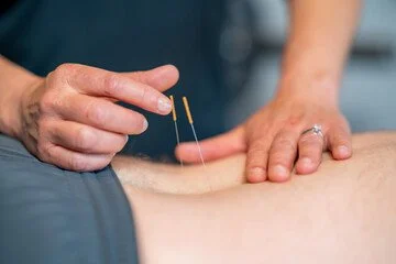 Dry needling close up