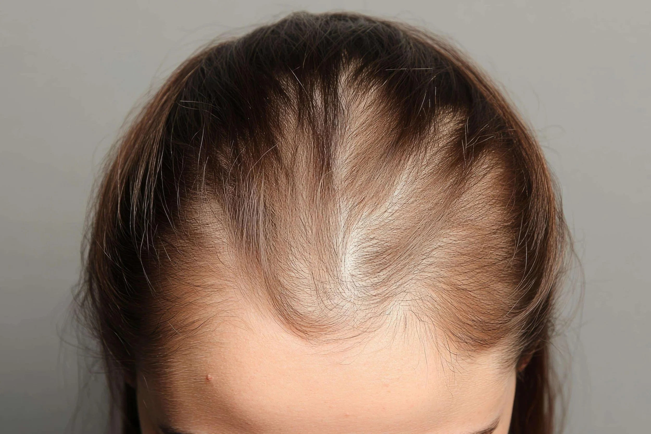 Alopécie féminine — perte de cheveux diffuse