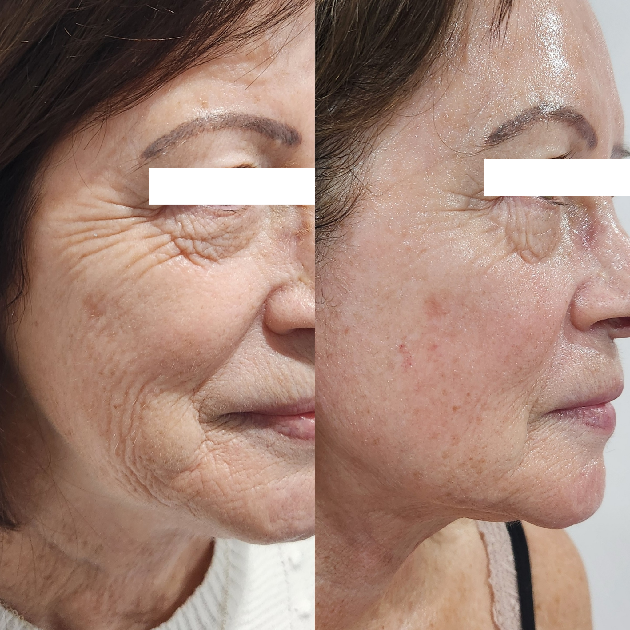 Nu Me Jawline Sculpt Before and After
