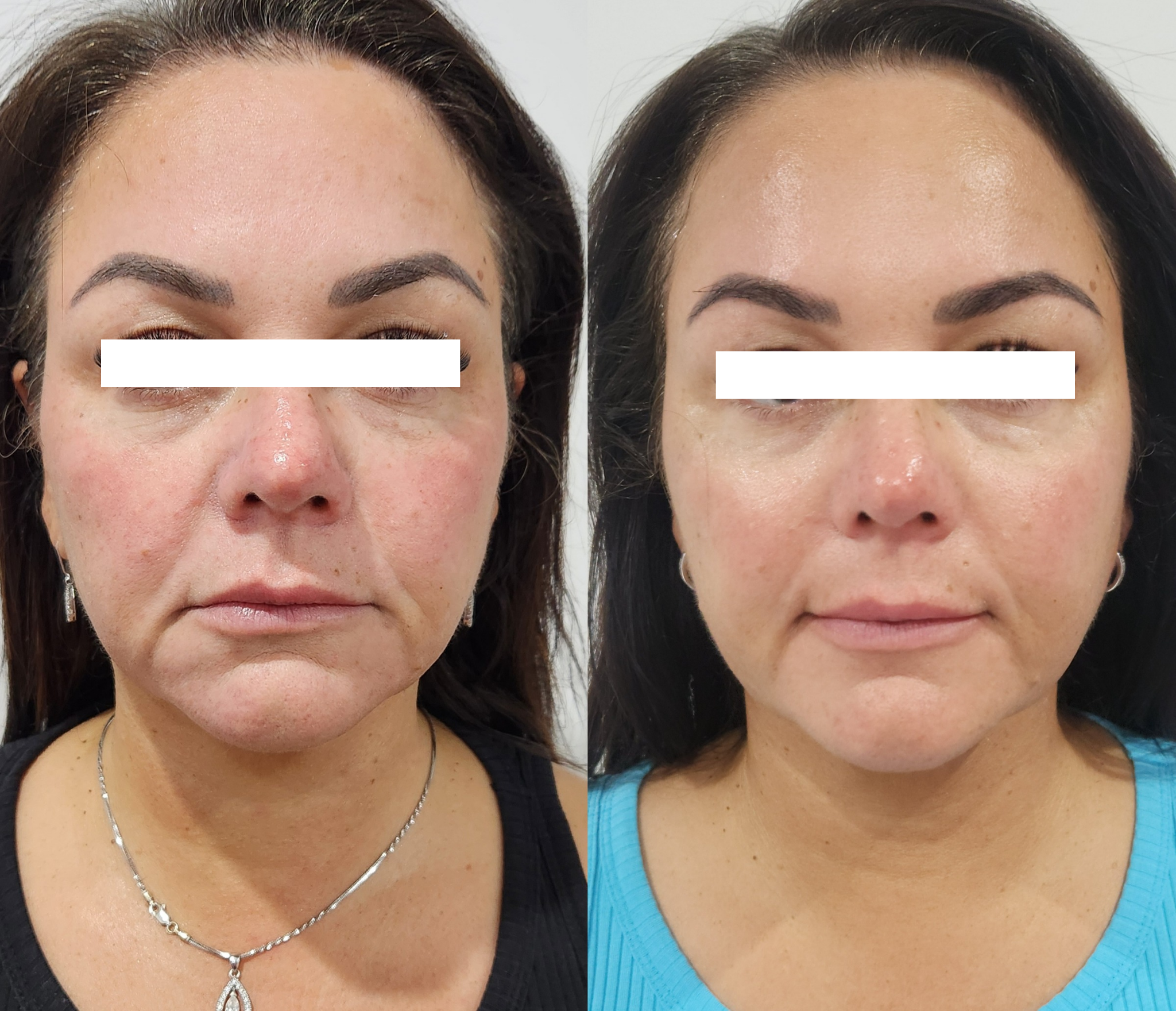 Real Nu Me Aesthetics client result