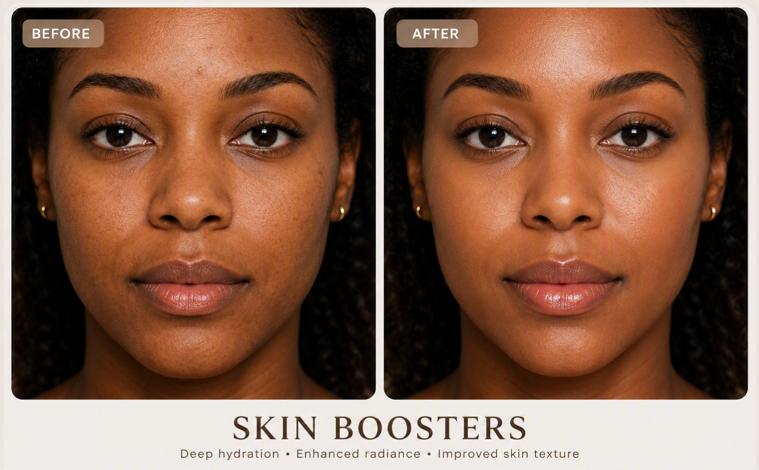 Skin Boosters before and after result