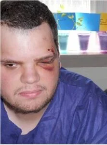  My son with a broken eye socket and 33 stitches, after suffering abuse and neglect in a “community” setting. 