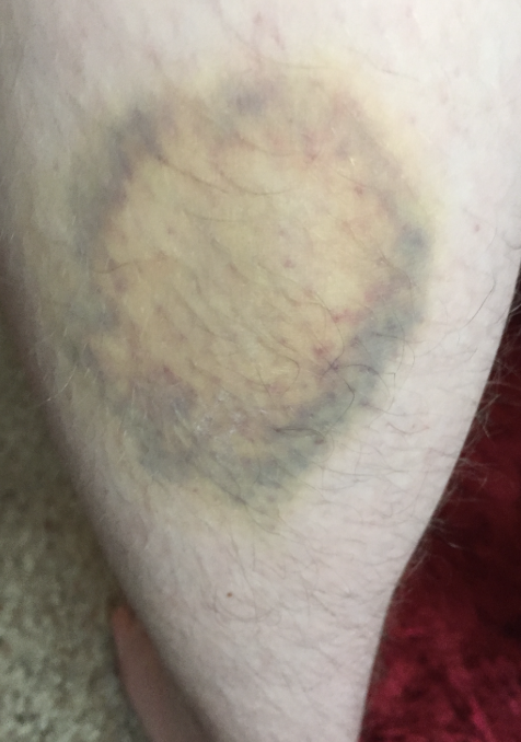 Figure 1: A hematoma on Caroline’s leg (photo provided by family; used with permission).