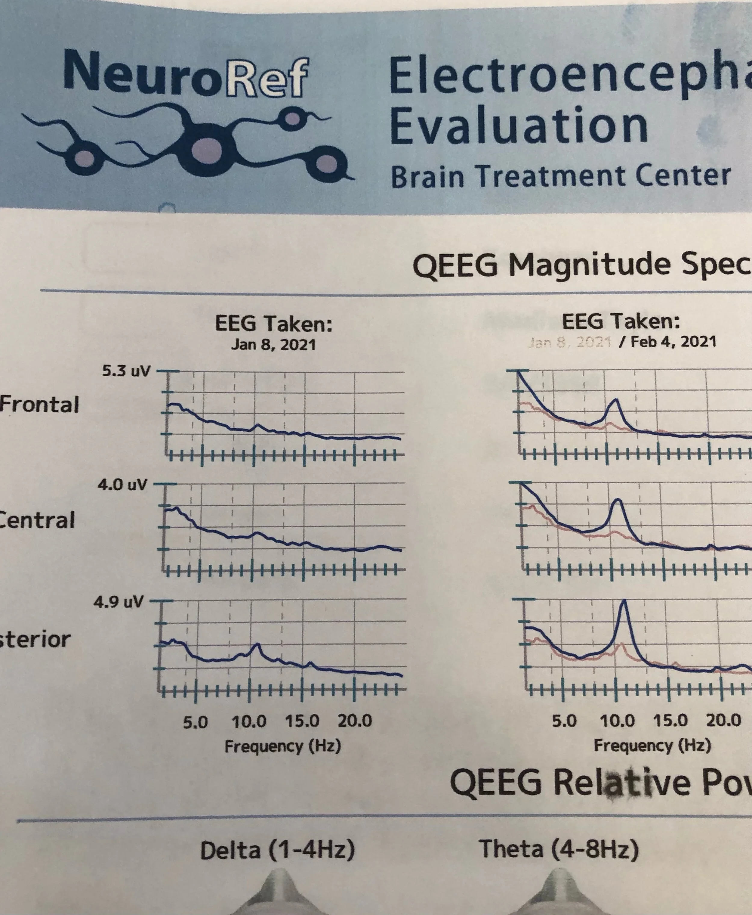  Changes in Madison’s EEG seen after a month of treatments. 