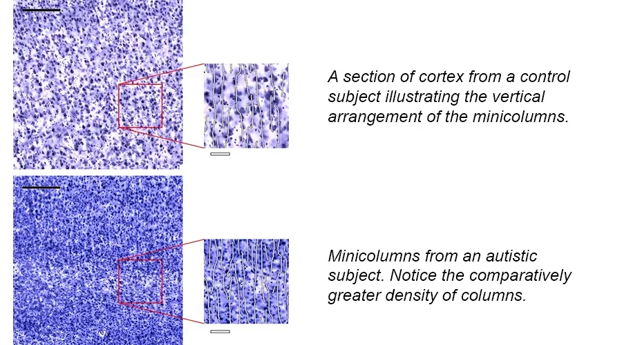  The vertical configuration acquired by migrating neurons within the cerebral cortex provide a virtual ecosystem that establishes the excitatory/inhibitory bias in the brain. (Image courtesy of Dr. Manuel Casanova) 