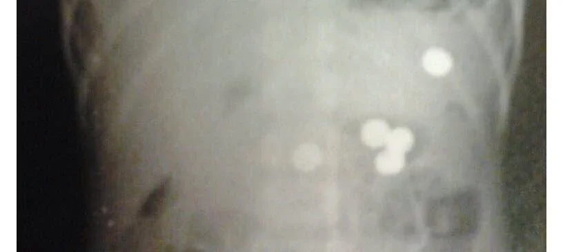  From an X-ray finding batteries inside Kayla’s abdomen. 