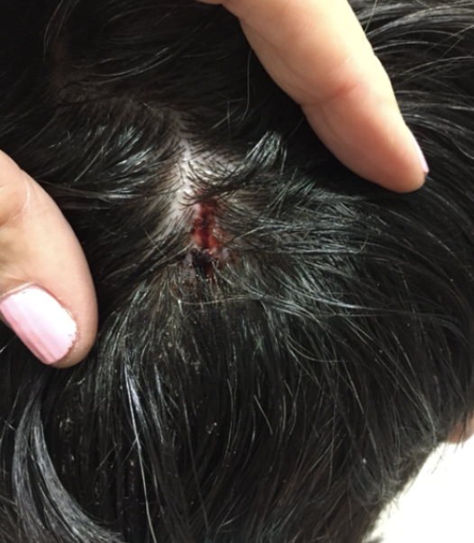 Figure 2: A bleeding laceration on Caroline’s scalp (photo provided by family; used with permission).