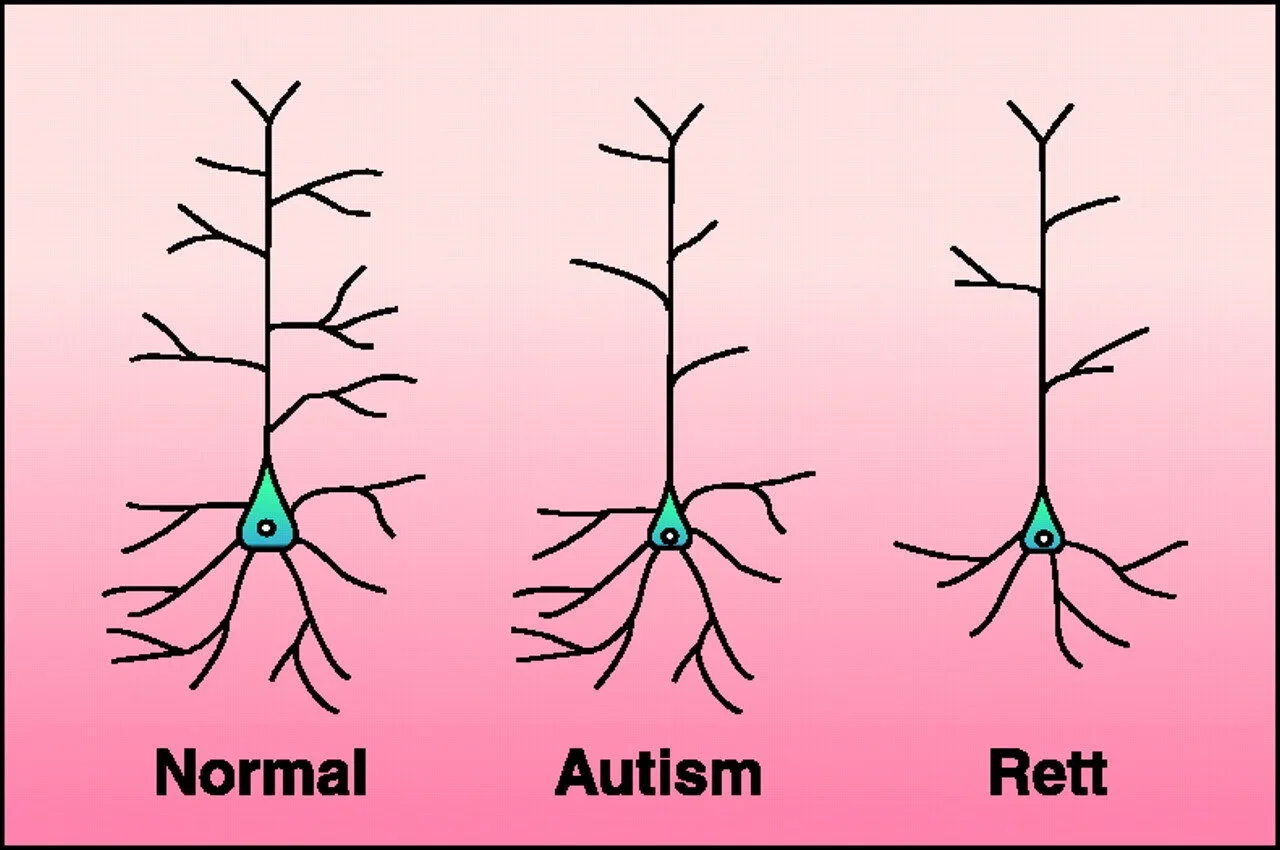   Dendritic impairments.  A simple schematic showing decreased dendtric spines in a pyramidal neuron in an autism brain. (From Zoghbim Science 3003) 
