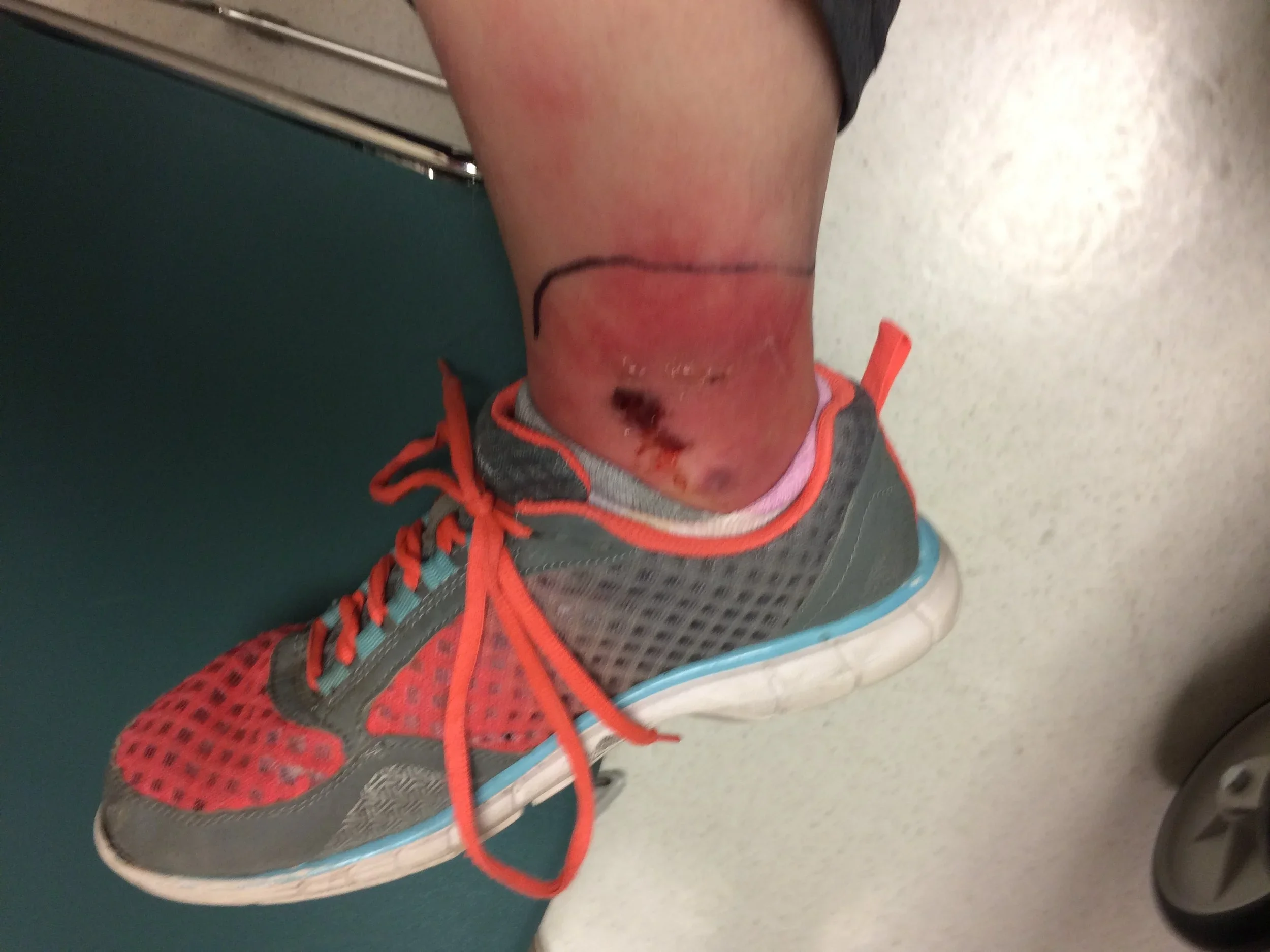  After a bee sting triggered cellulitis in the author’s severely autistic daughter, they sought treatment at an ER. 