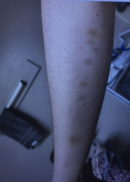  Figure 3: A row of pattern bruises on Caroline’s arm (photo provided by family; used with permission). 