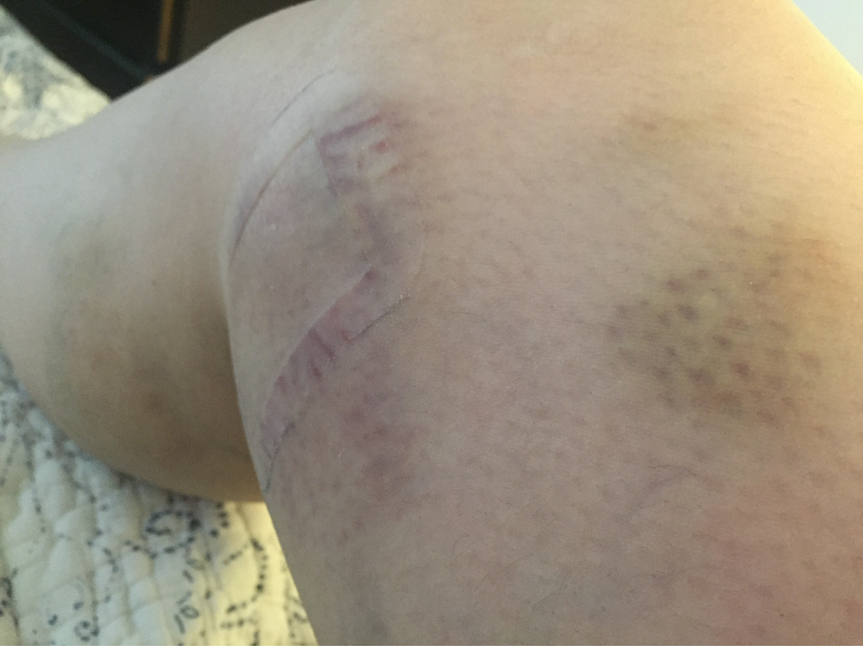  Bites have left bruises all over M’s mother, including her legs. 