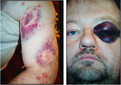  “The behaviors reached a fever pitch that ended with extensive injuries to myself and Josh.” Here, two photos of the author after a series of his son’s aggressions. 