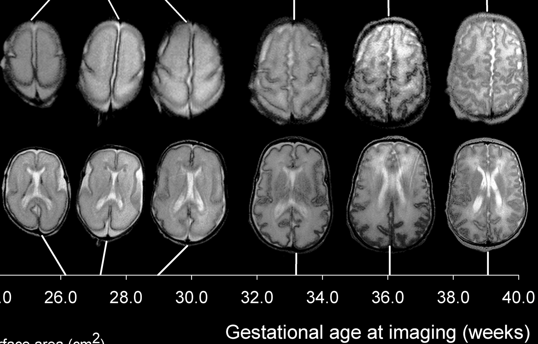  Human cortical development between 26 and 39 weeks of gestational age. (Image: Wikipedia) 