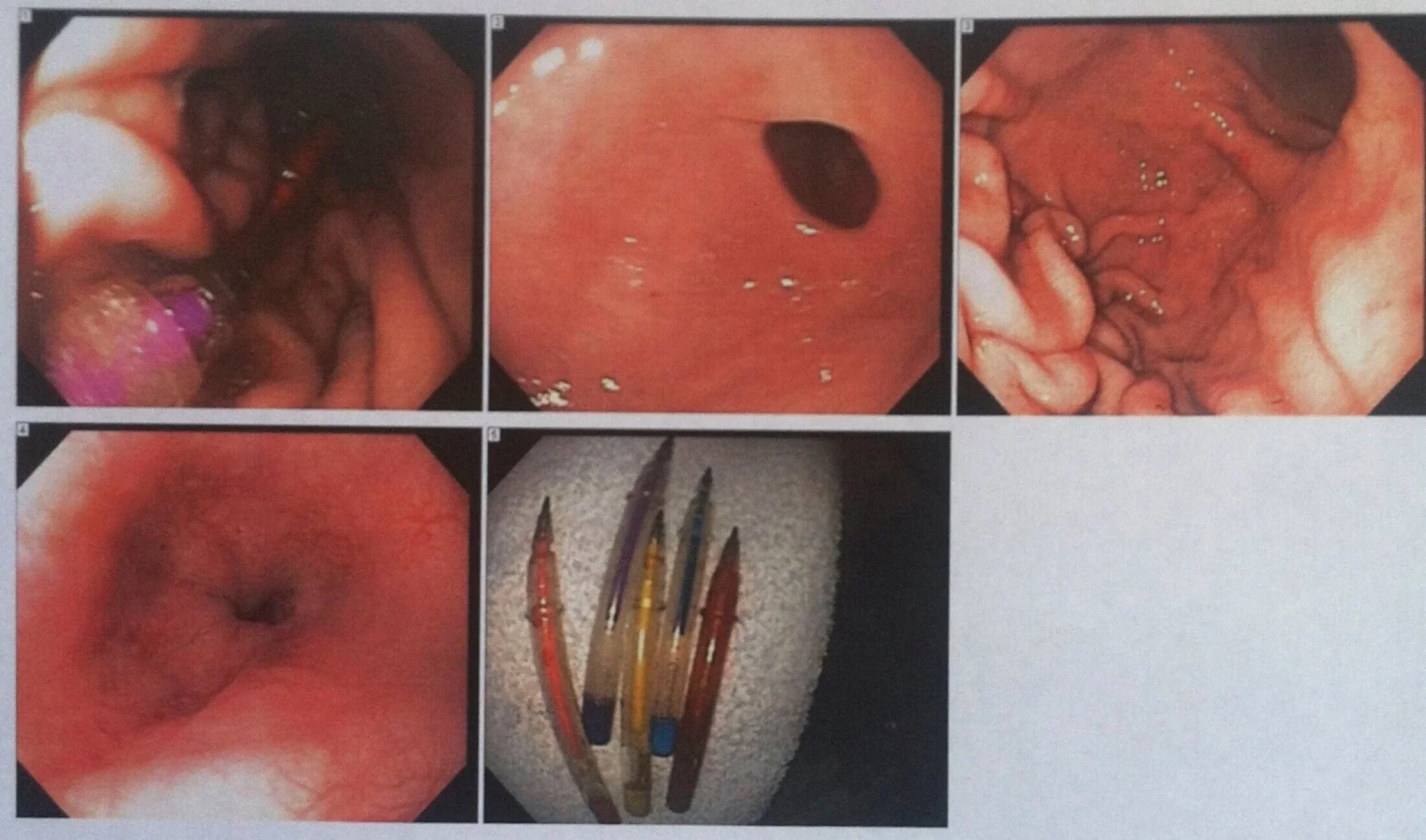  Images from the endoscopic removal of the pens. 
