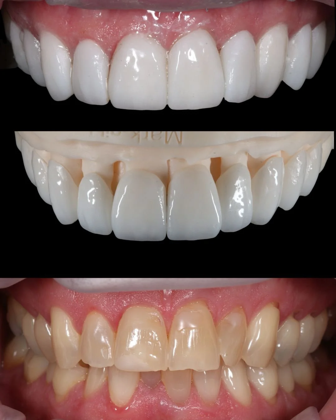 Veneer result 1