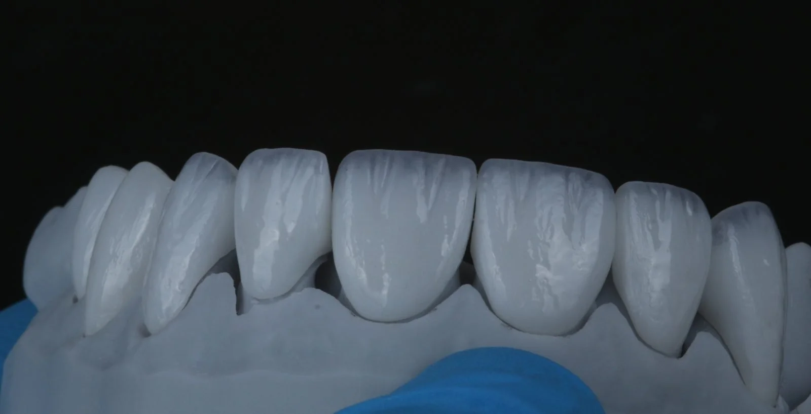 Millineer ceramic veneers in a bright white shade, on the lab model
