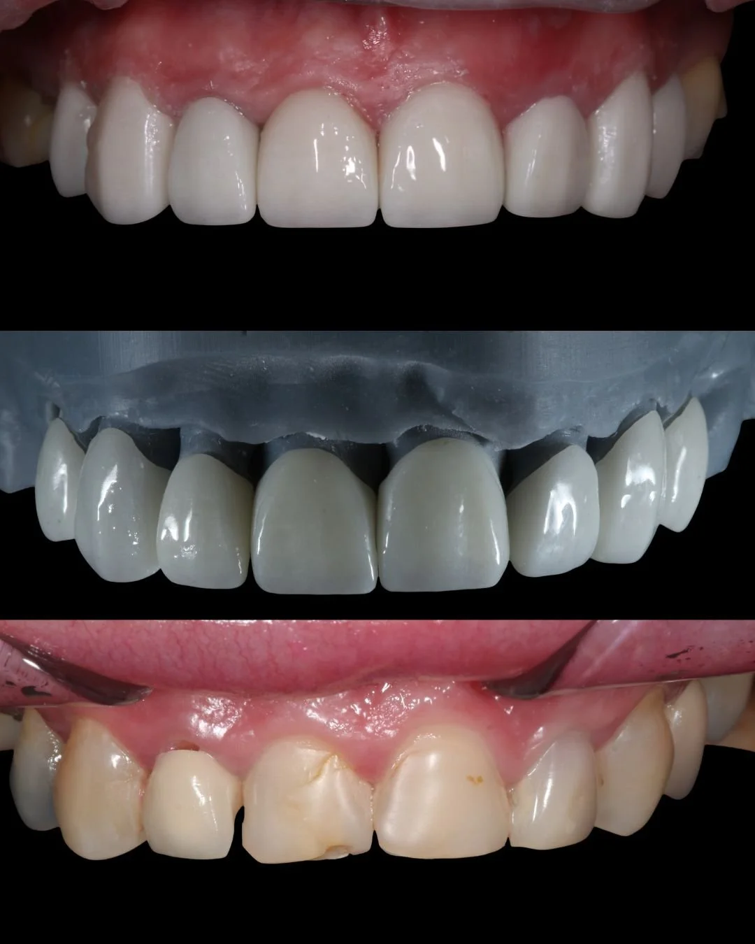 Veneer result 3