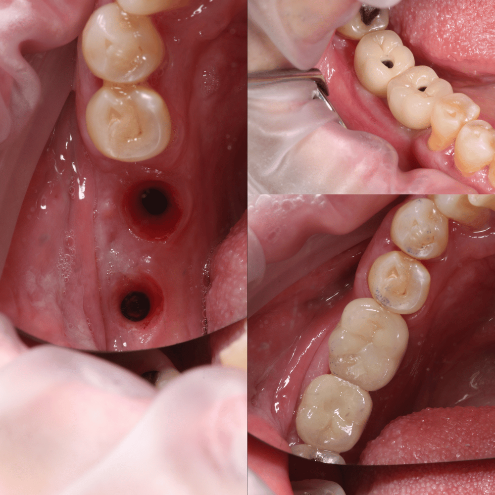 Implant before and after, case 4