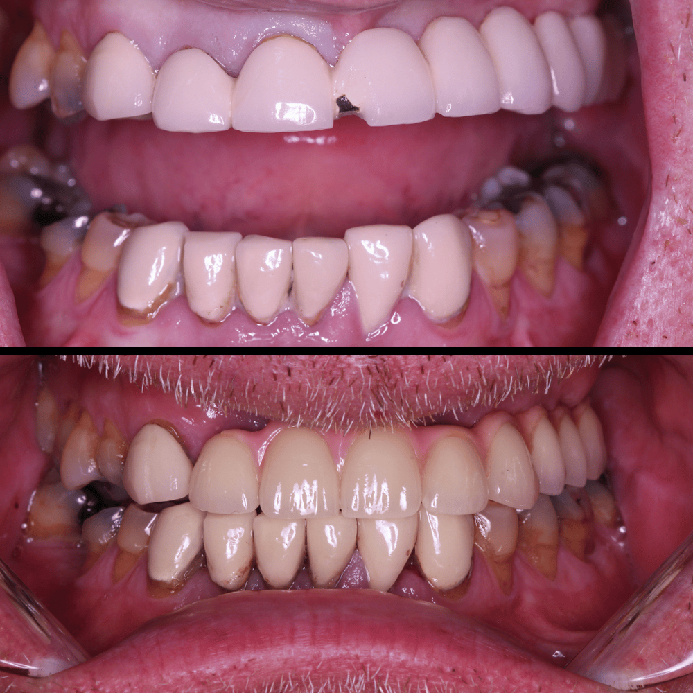 Implant before and after, case 3