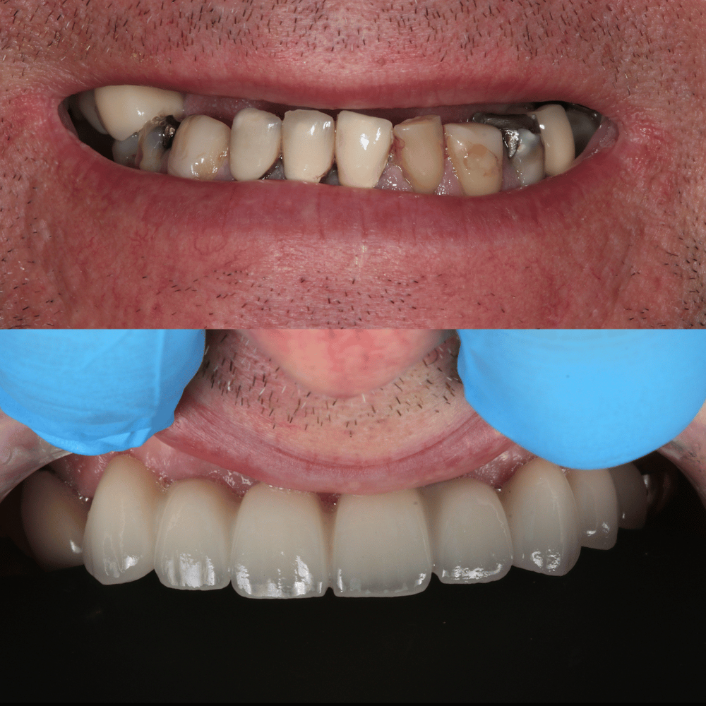 Implant before and after, case 1
