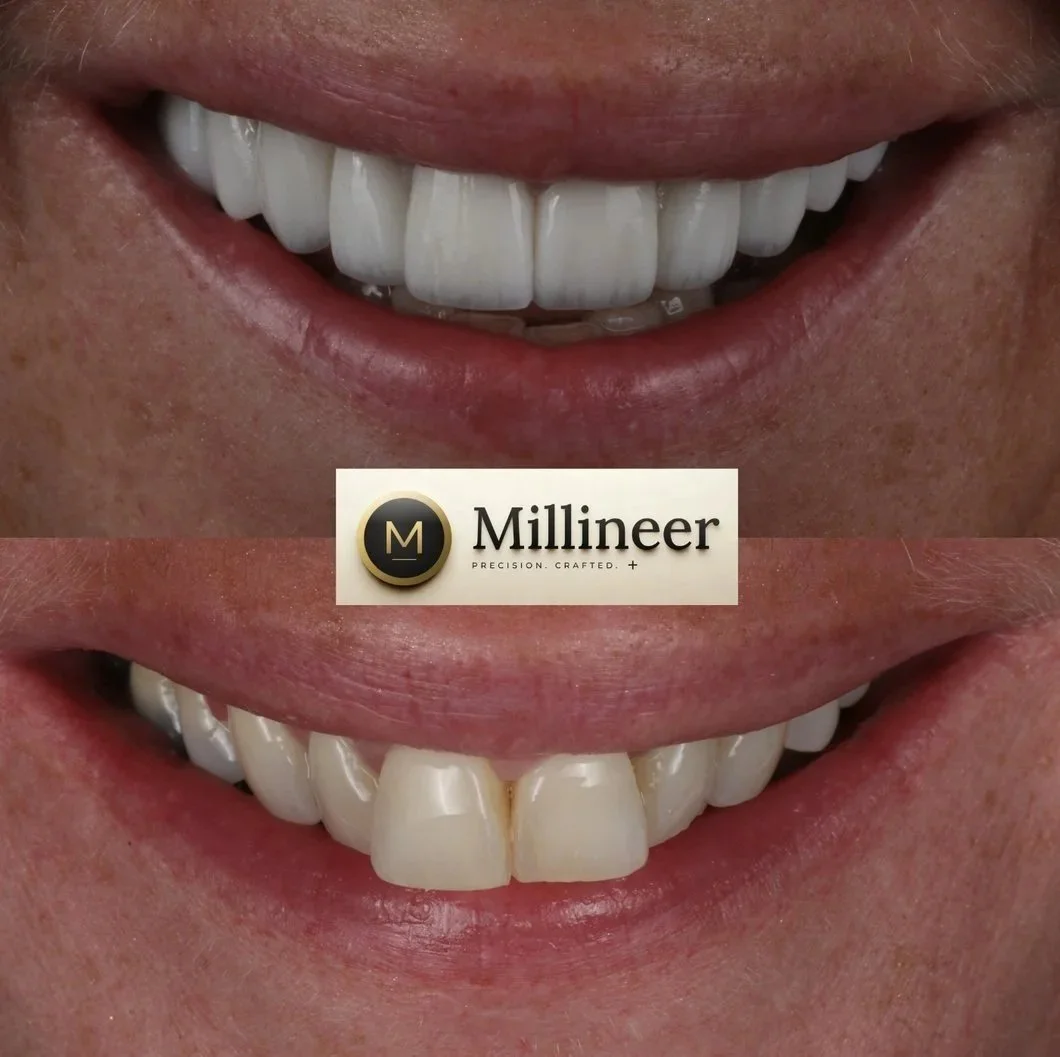 Millineer veneer patient, before and after