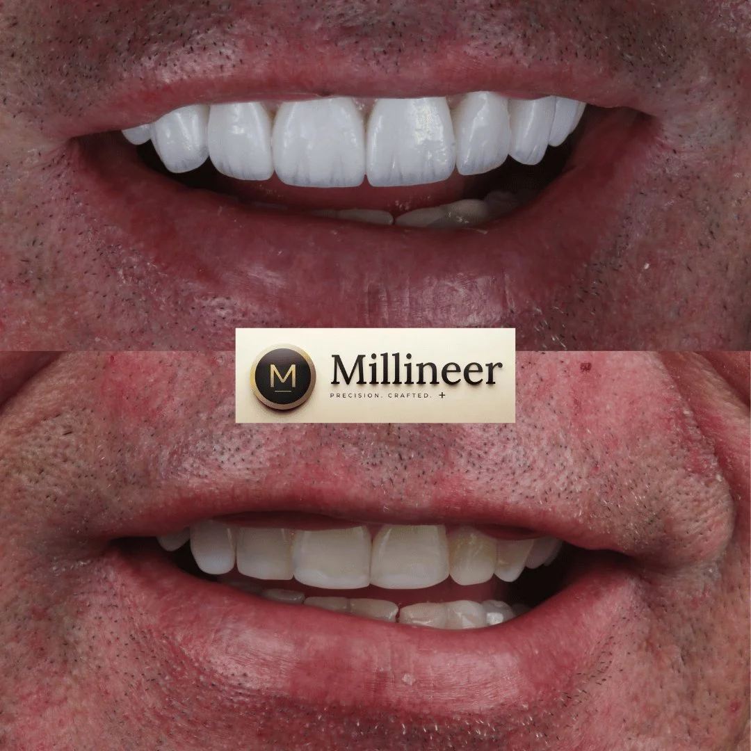 Veneer before and after, Millineer