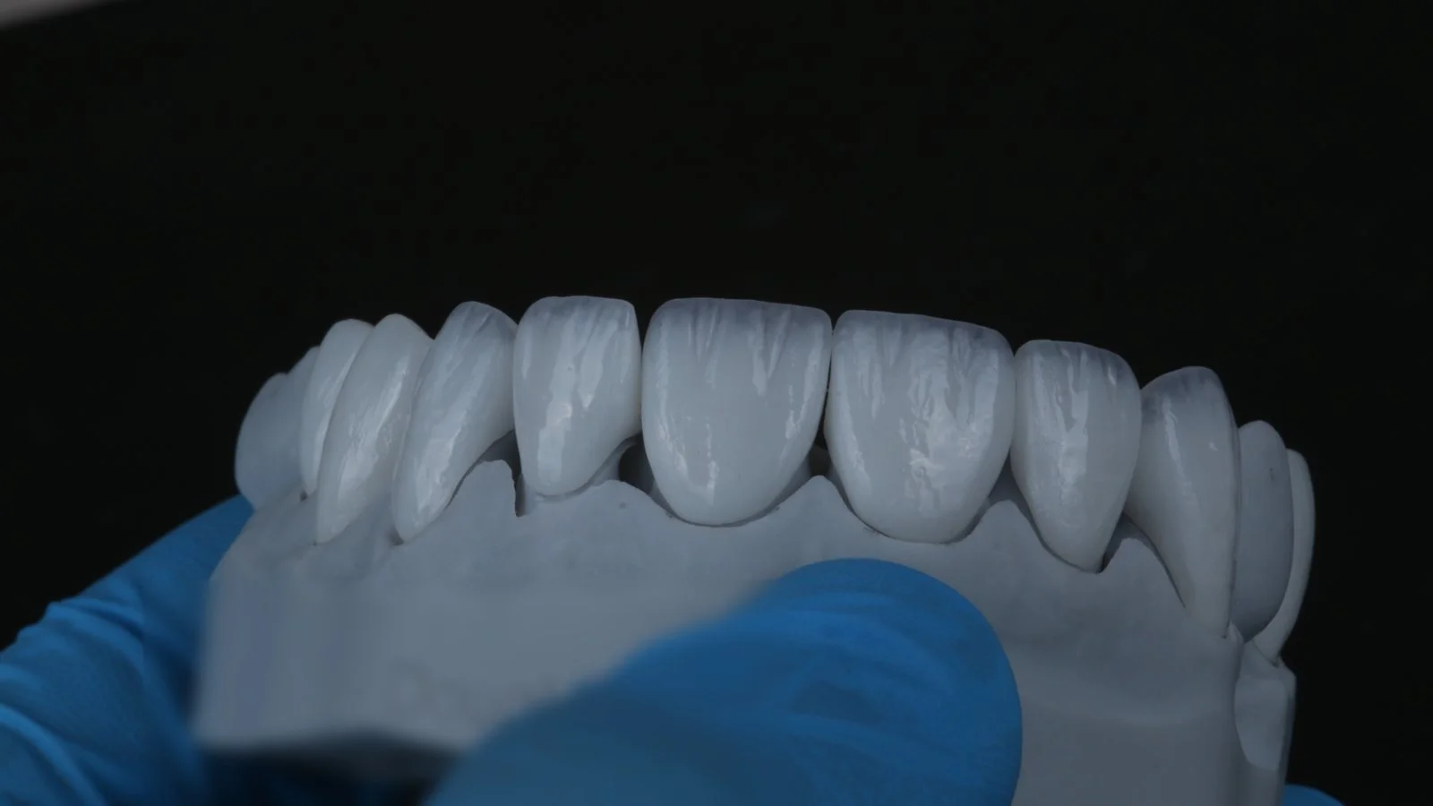 Millineer ceramic veneers in a bright white shade, on the lab model