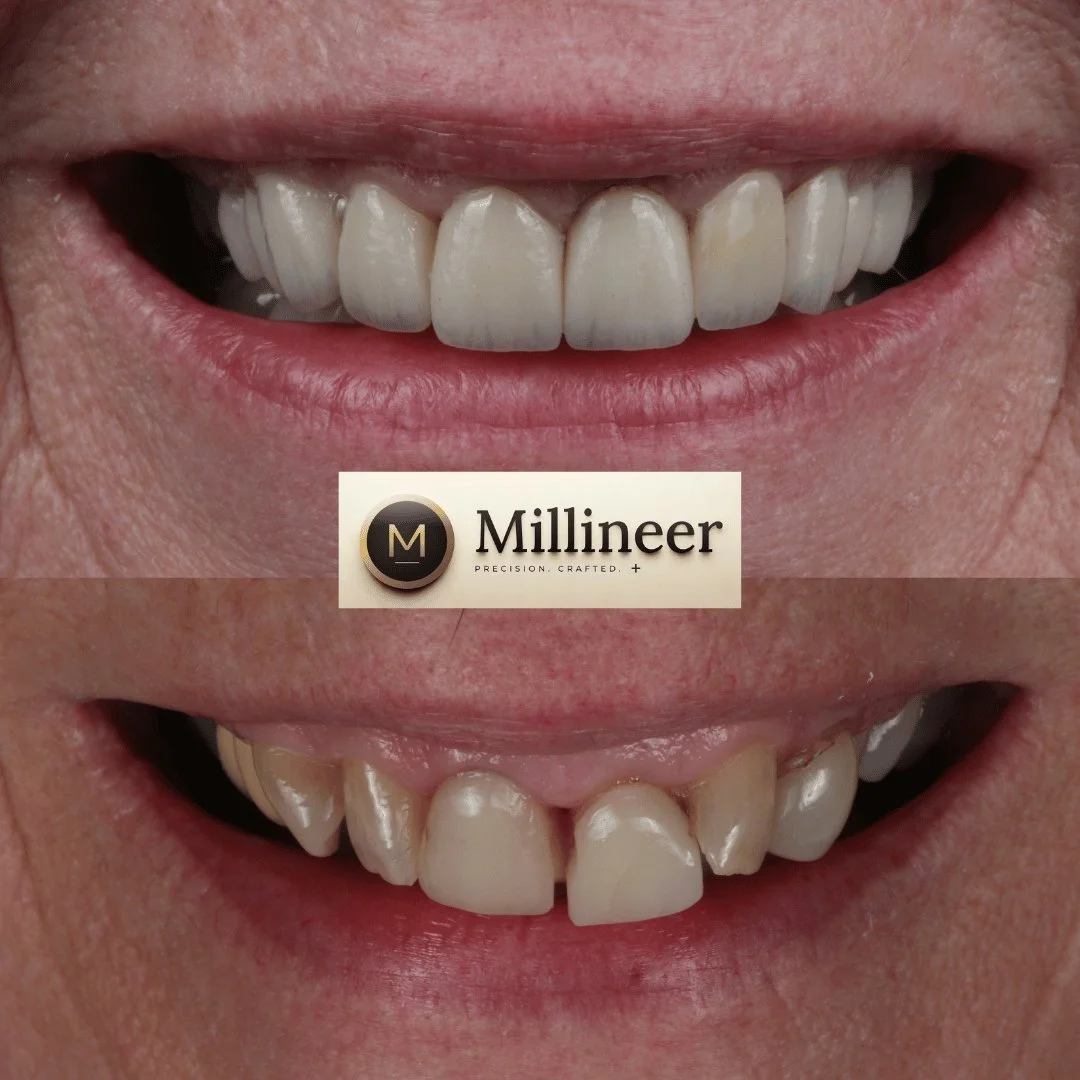 Veneer before and after, Millineer