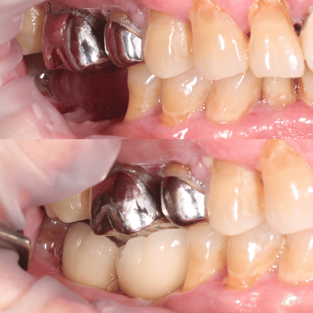 Implant before and after, case 5