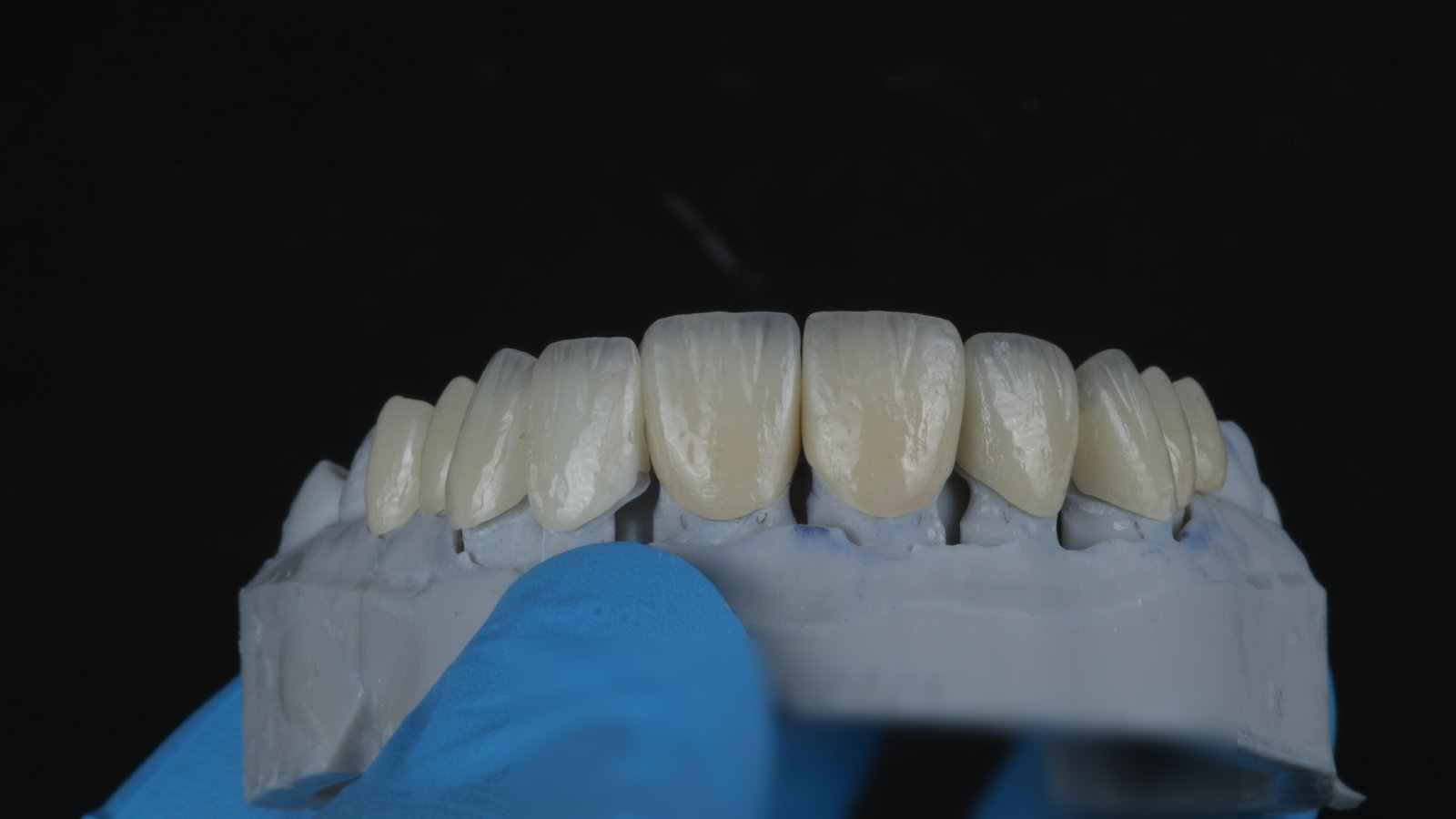 Millineer ceramic veneers in a natural shade, on the lab model