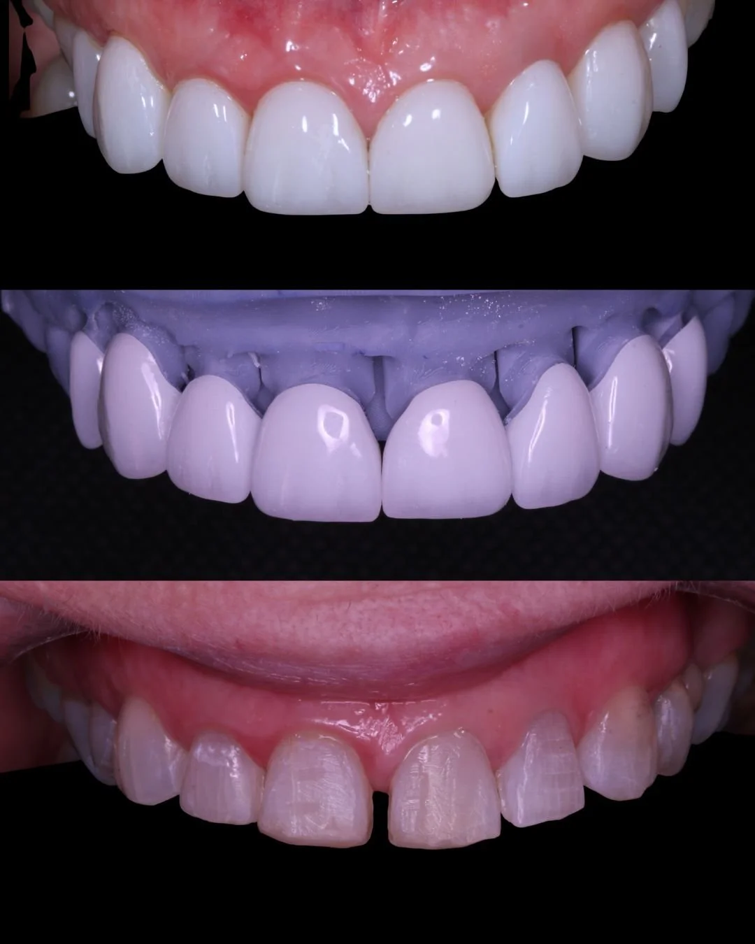 Veneer result 2