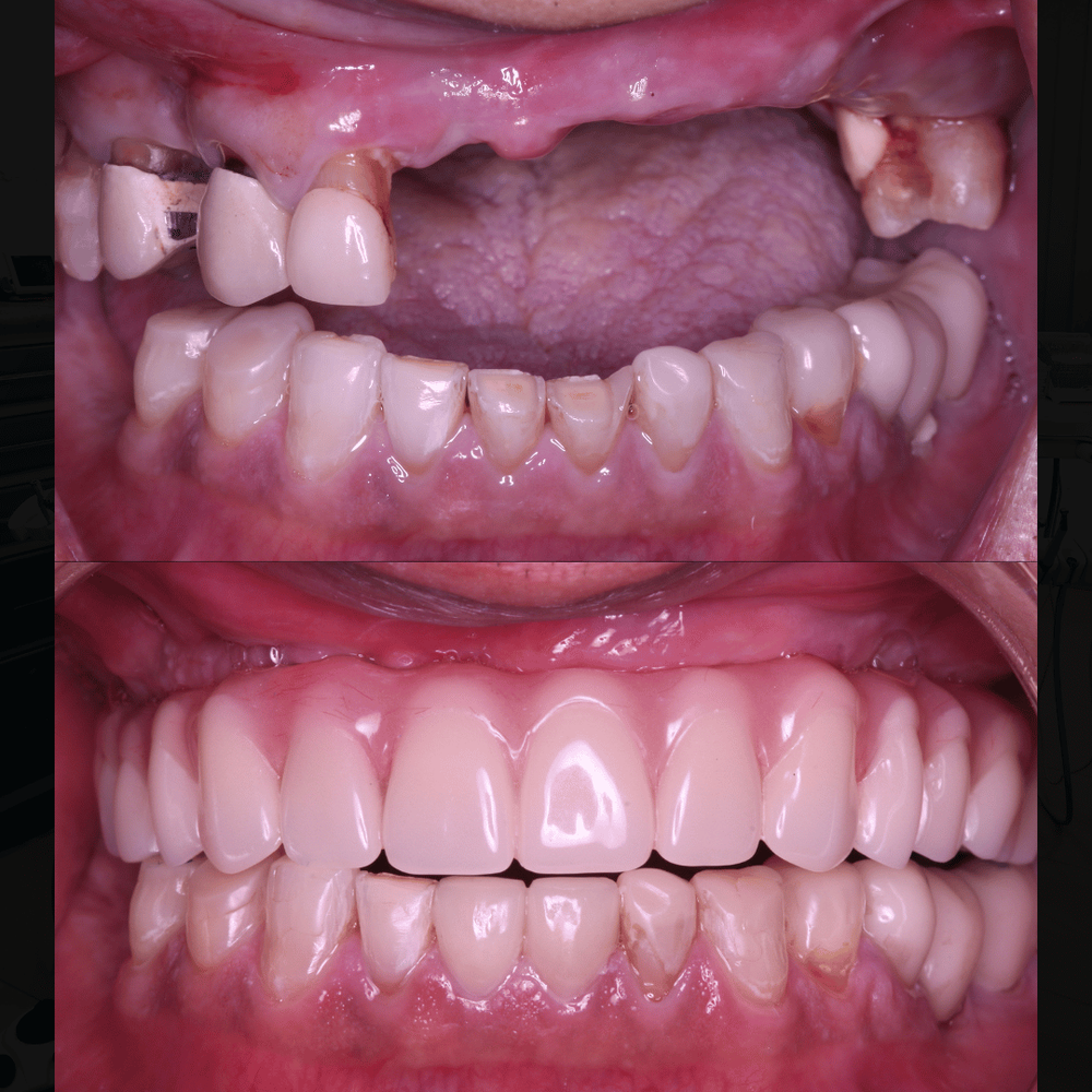 Implant before and after, case 2