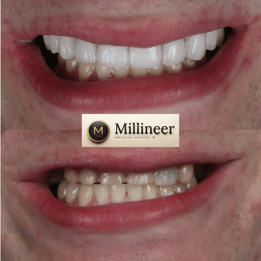 Veneer before and after, Millineer