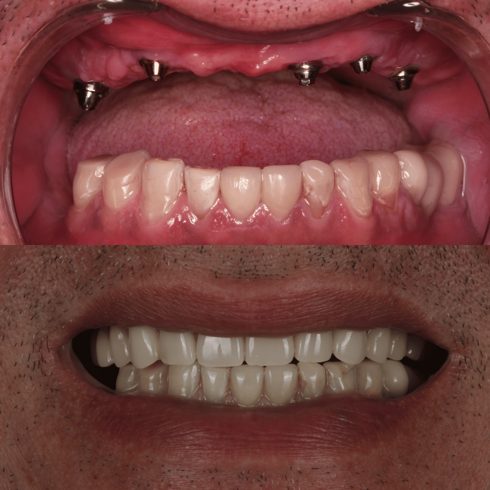 Millineer dental implant before and after