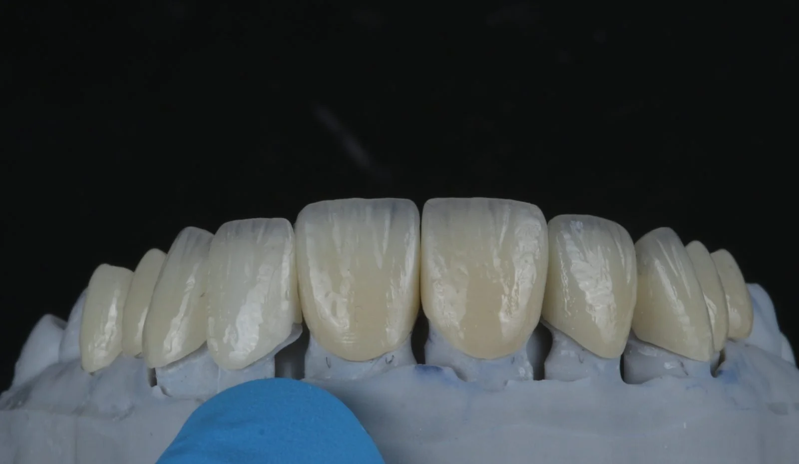 Millineer ceramic veneers in a natural shade, on the lab model