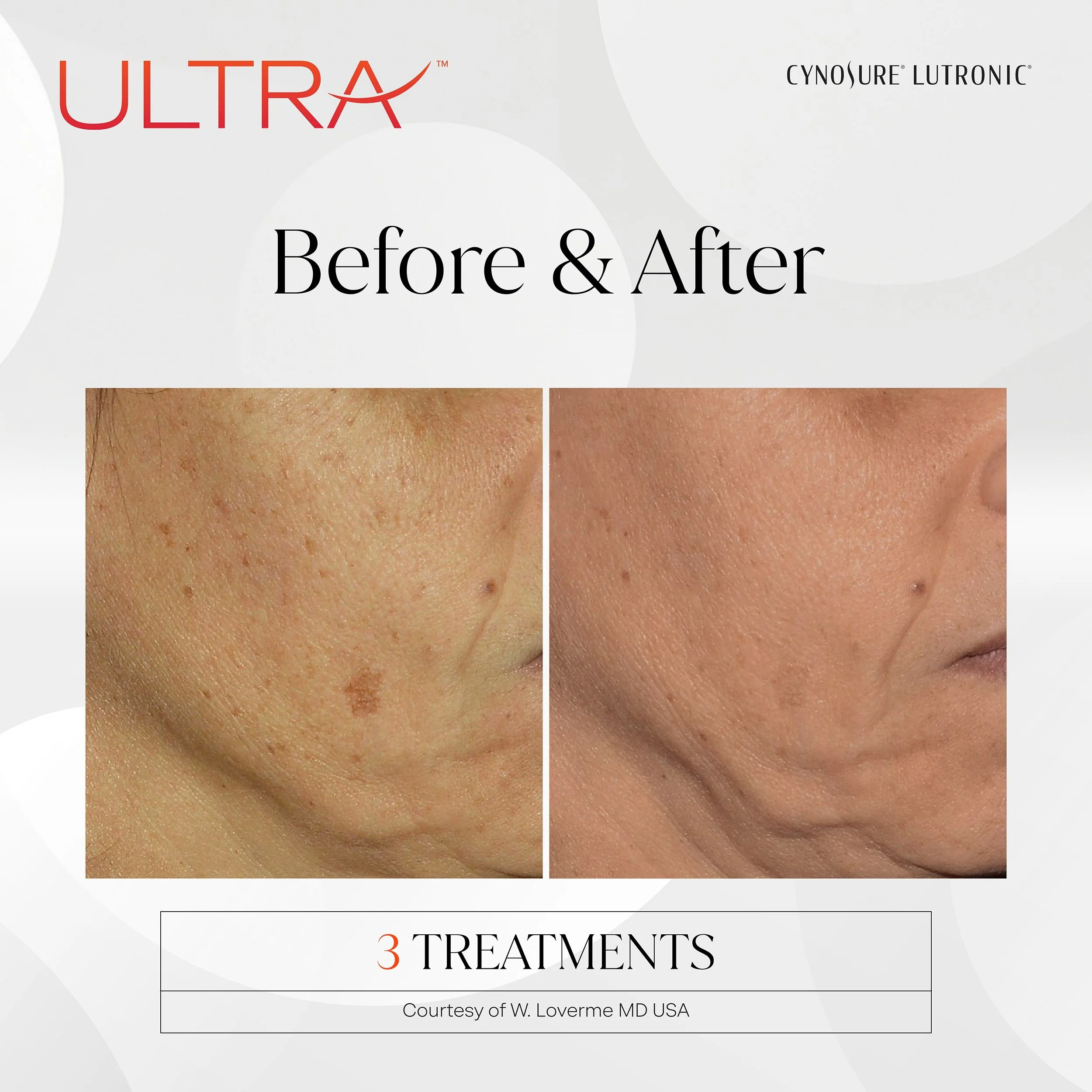 LaseMD Ultra before and after, cheek and jawline, 3 treatments