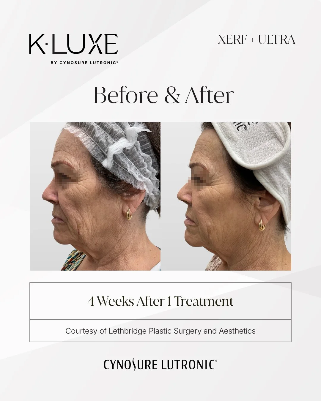 K-LUXE (XERF + LaseMD Ultra) before and after, 4 weeks after 1 treatment