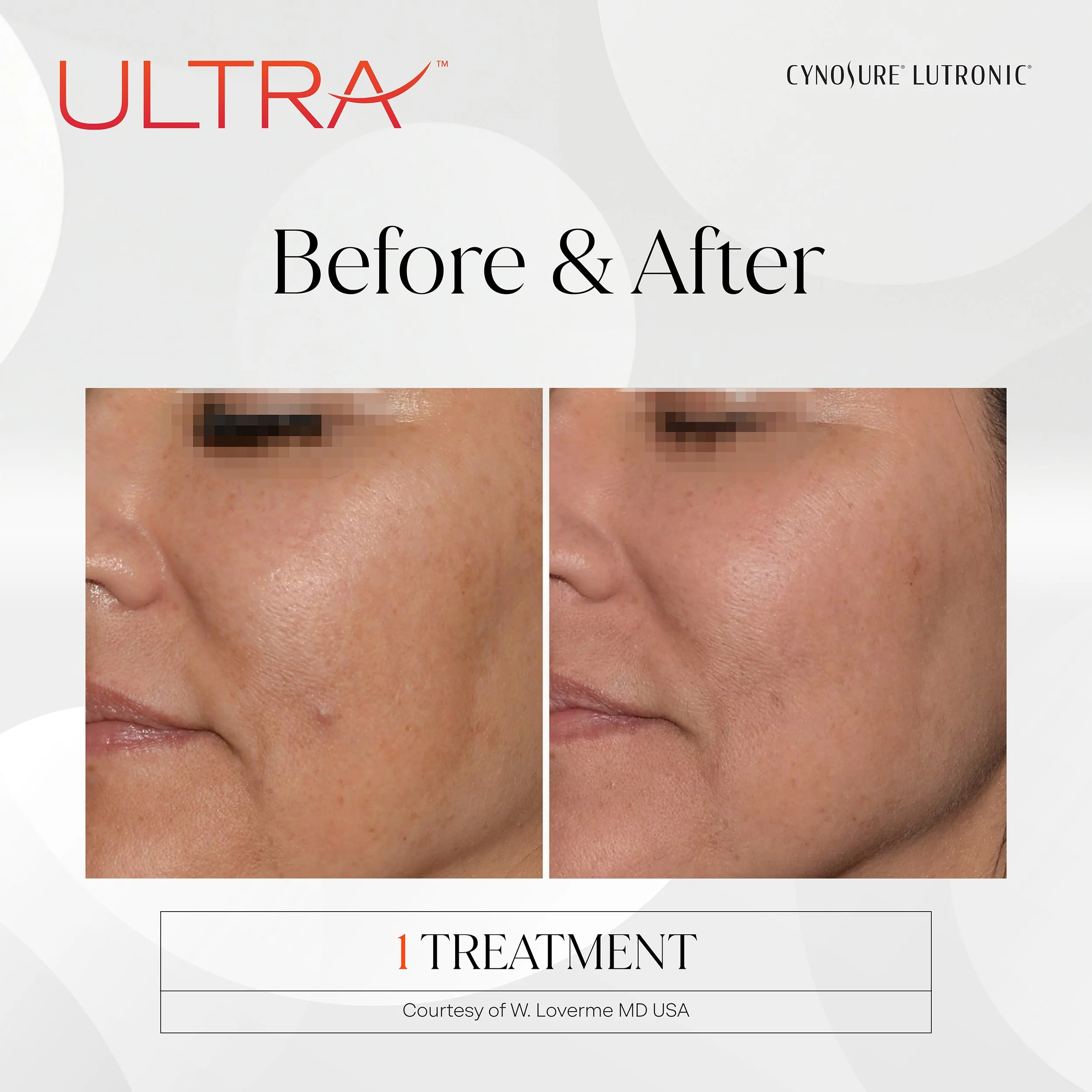 LaseMD Ultra before and after, side of the face, 1 treatment
