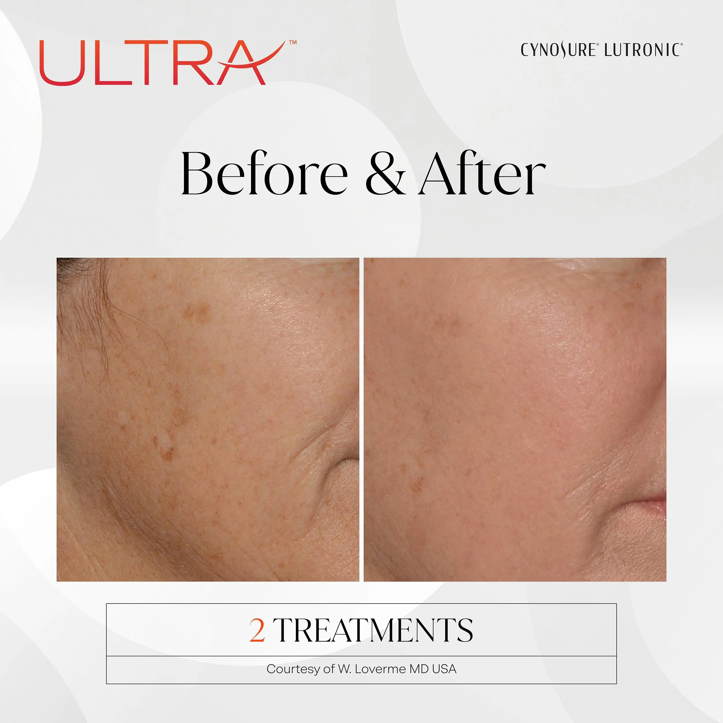 LaseMD Ultra before and after, cheek, 2 treatments