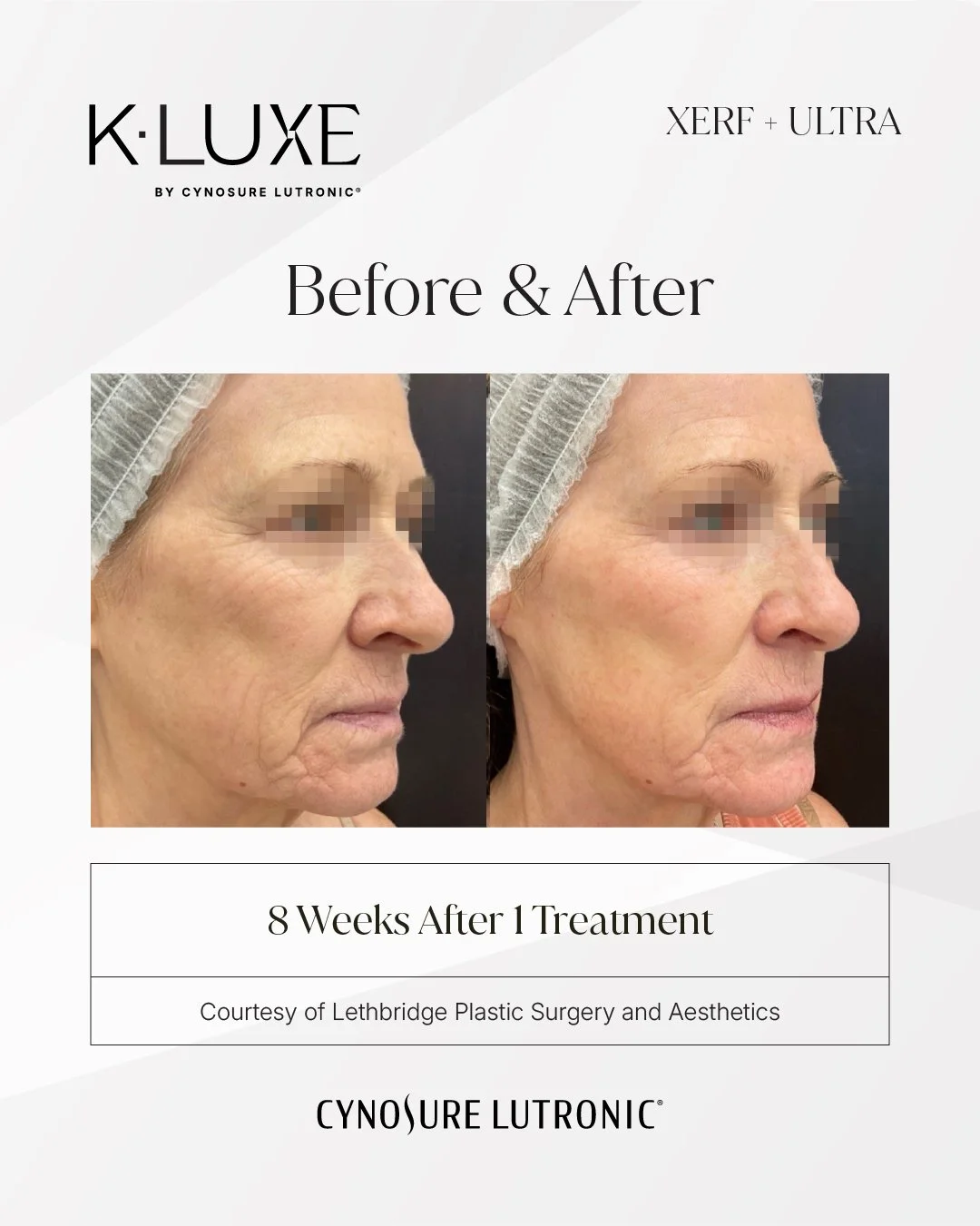 K-LUXE (XERF + LaseMD Ultra) before and after, 8 weeks after 1 treatment
