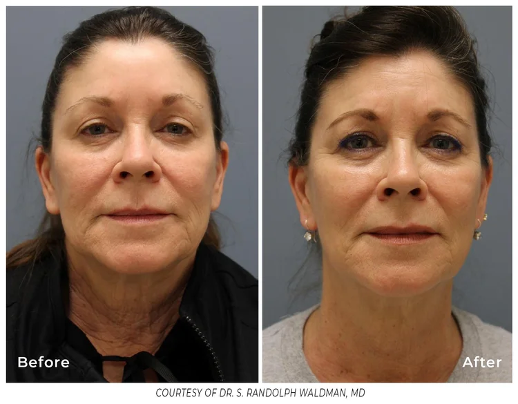 Pixel8 RF microneedling treatment