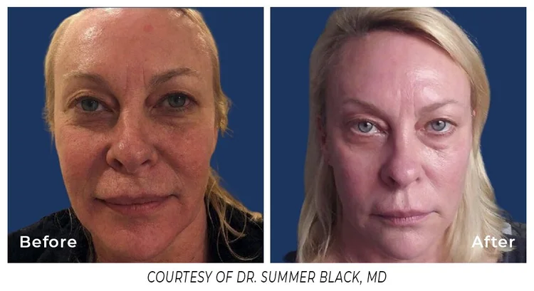 Spectrum laser used for 10-minute YAG treatments